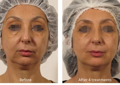 Oxygeneo facial Before and after four treatments
