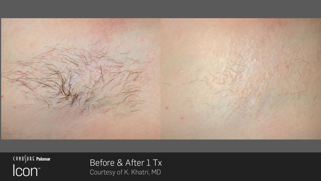 Laser hair removal treatment on armpits. Before and after results.