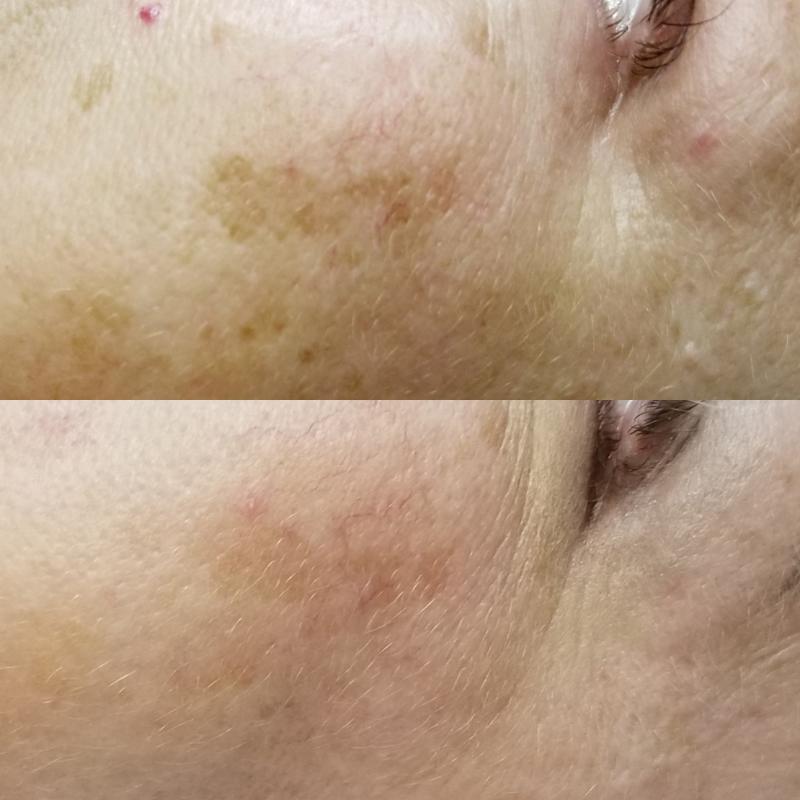 photofacial treatment Before and after image of a photofacial treatment for discolouration on the face.