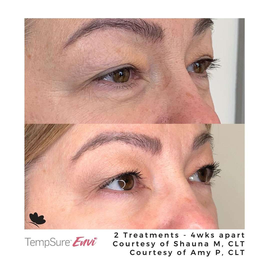 tempsure before and after treatment results on eye