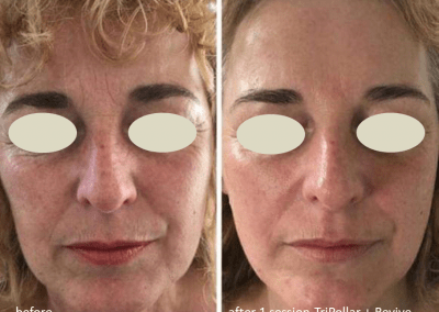 Oxygeneo before and after one treatment with TriPollar