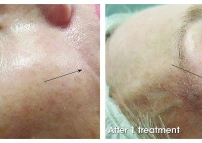 oxygeneo facial before and after treatment results