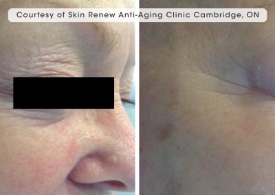 Oxygeneo facial before and after around the eye