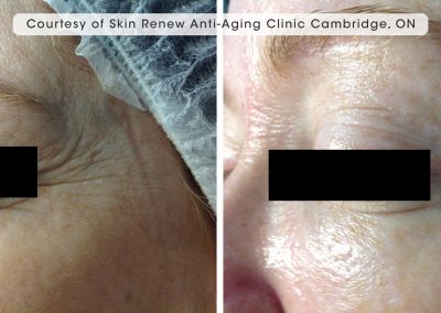Oxygeneo before and after facial treatment on the outter eye