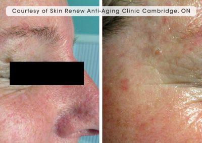 Oxygeneo before and after results around the eye area. Wrinkles are reduced.