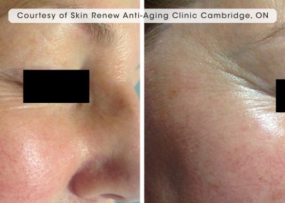 oxygeneo facial before and after treatment results around the eye