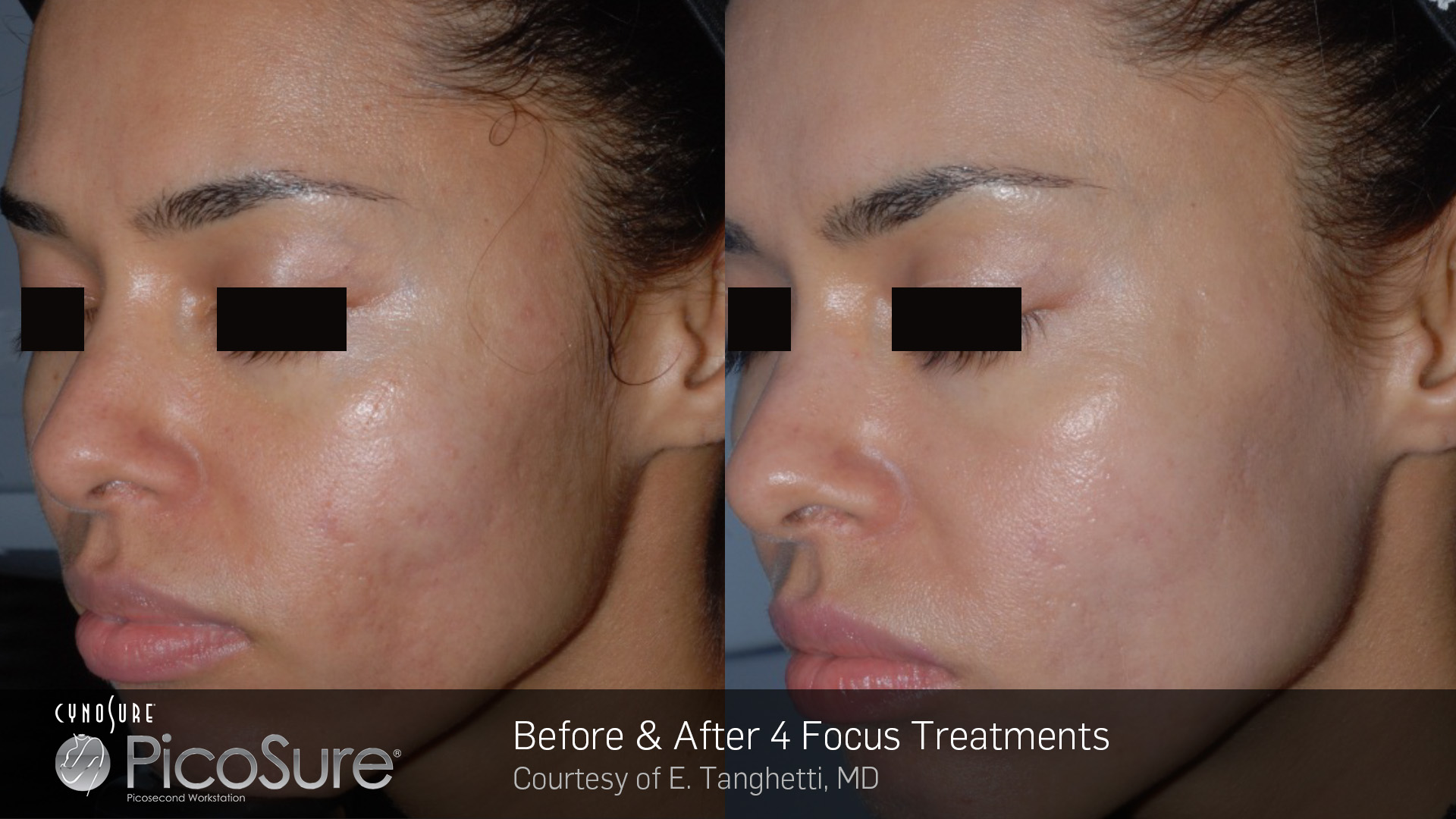 picosure results face before and after