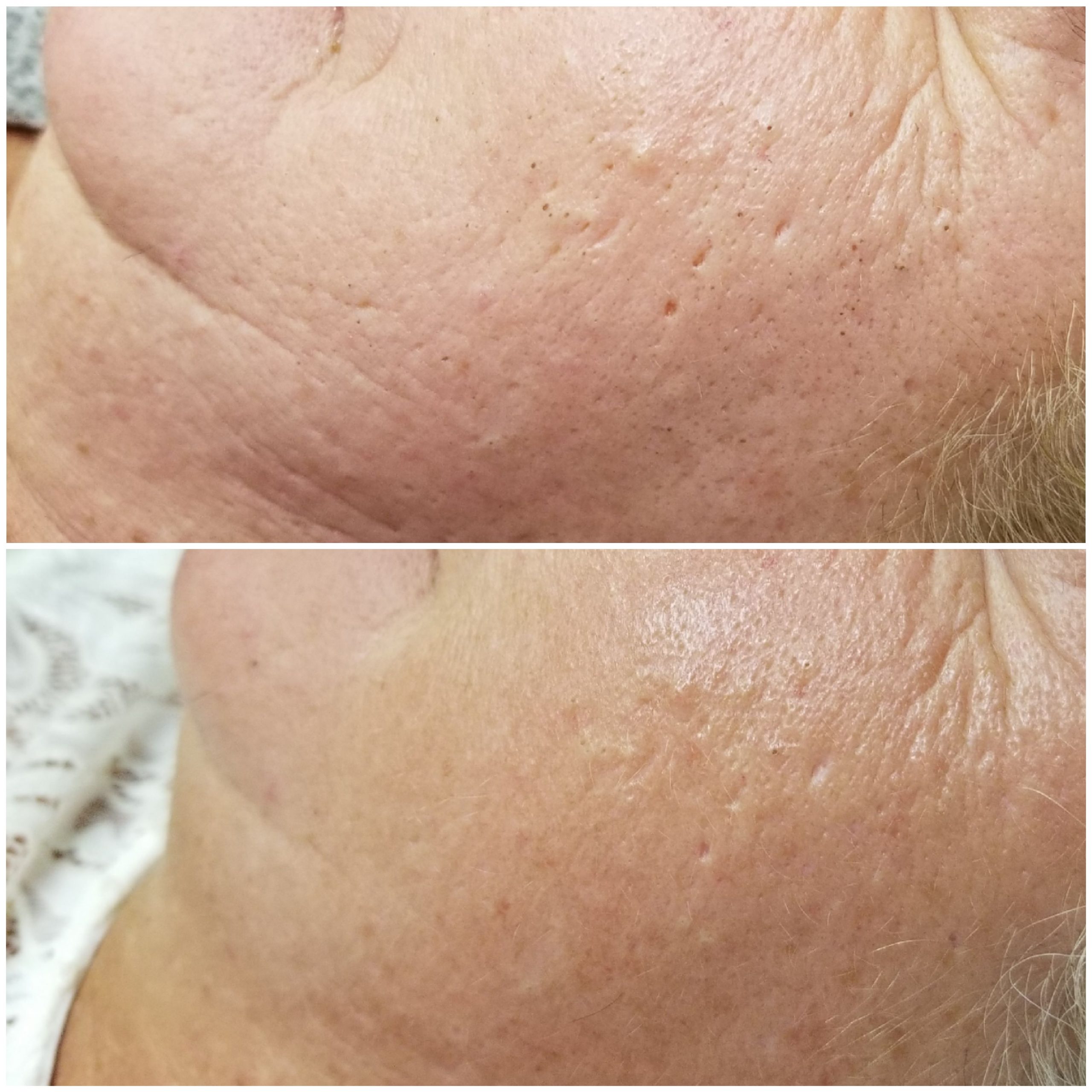 Before and after 2 treatments, 4 weeks apart