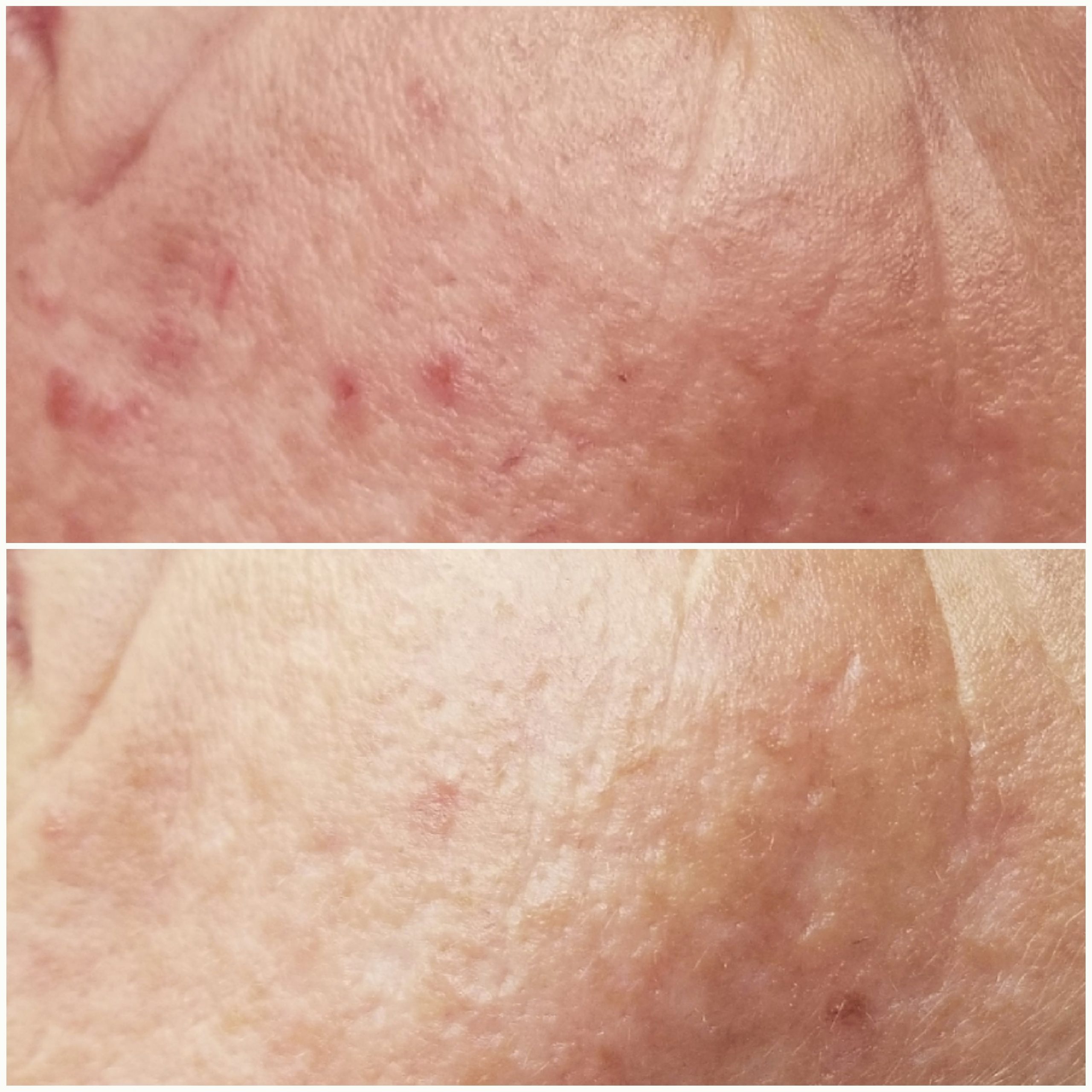 microneedling service before and after acne treatment results