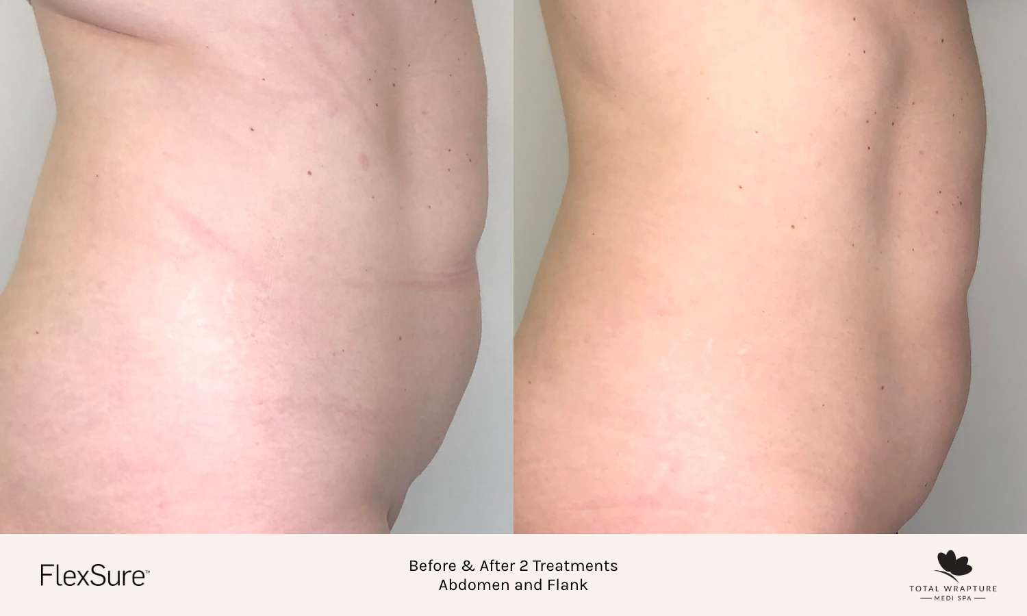 Before and after results of a FlexSure abdomen and flank treatment