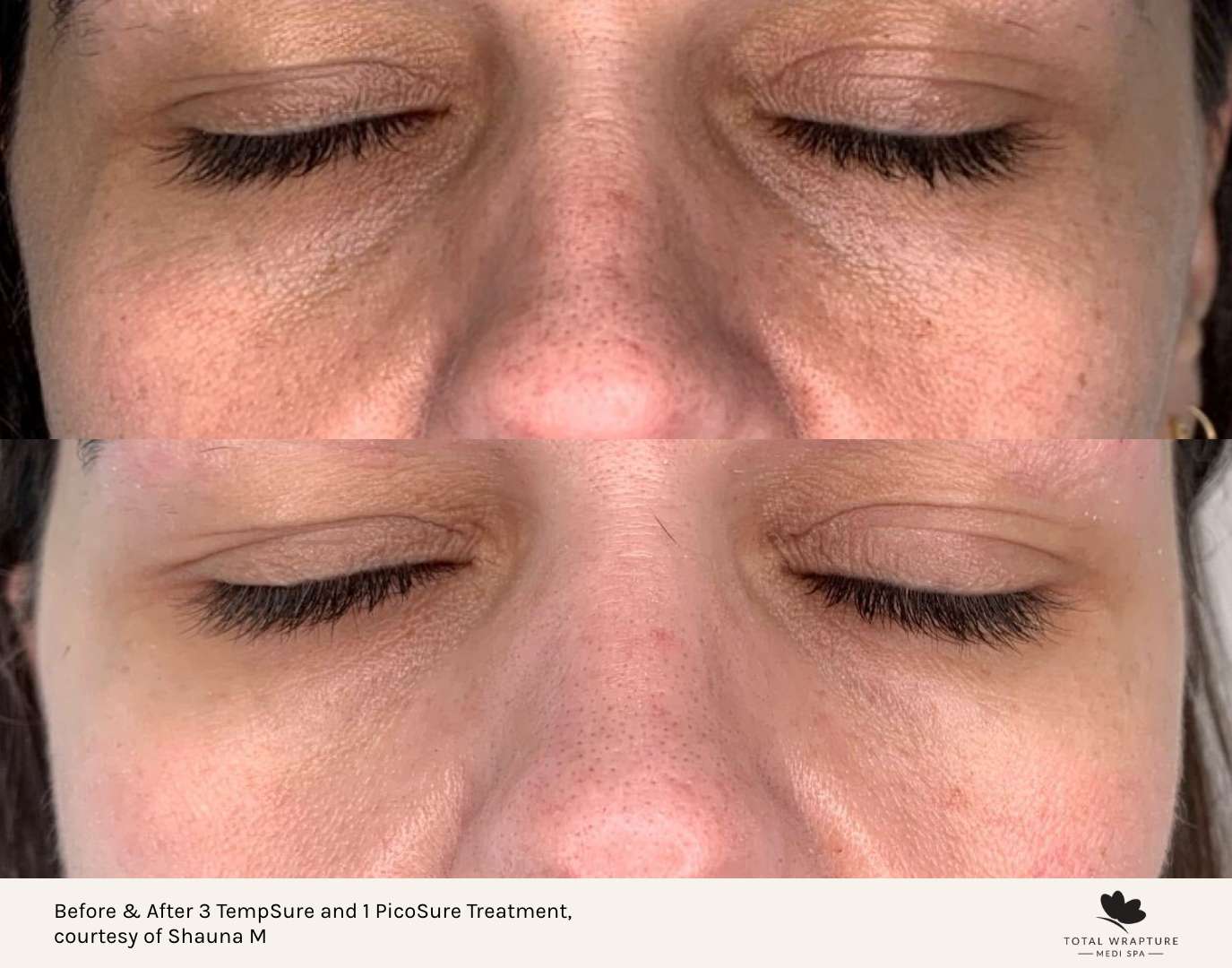 picosure laser winnipeg before and after image of skin rejuvenation with picosure treatment