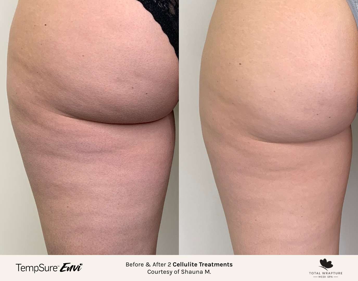Cellulite treatment in Winnipeg for hips and buttocks.