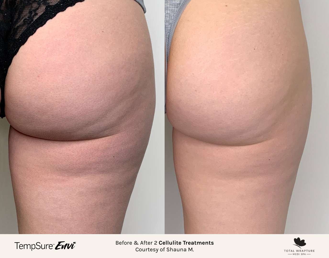 Before and after results of a TempSure Envi cellulite treatment on the buttocks.