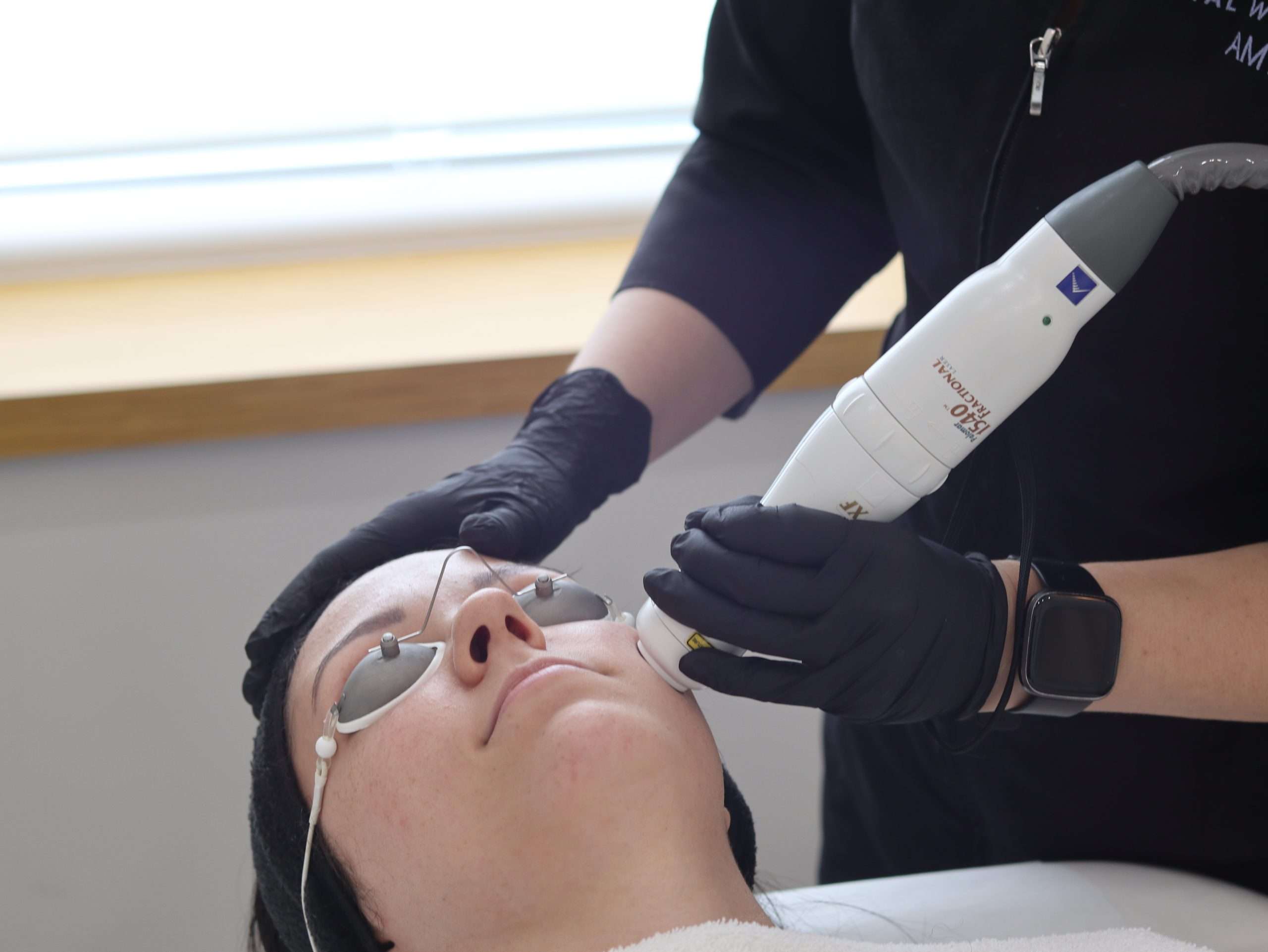 laser resurfacing winnipeg treatment