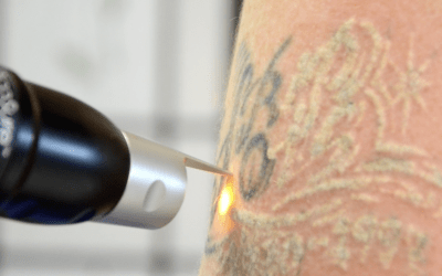 How Does Tattoo Removal Work in Winnipeg?