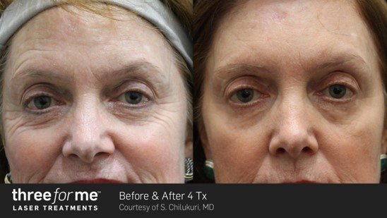laser treatment winnipeg ThreeForMe before and after results of 4 treatments. Pigmentation treatment.