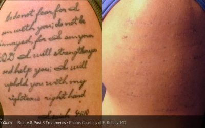 Fading vs. Full Removal: Laser Tattoo Removal in Winnipeg