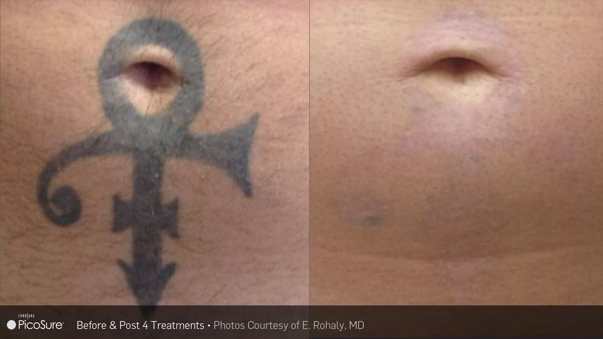 Before and after of laser tattoo removal of black ink tattoo around belly button area. Tattoo was removed.