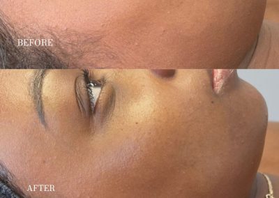 Dermaplaning before and after