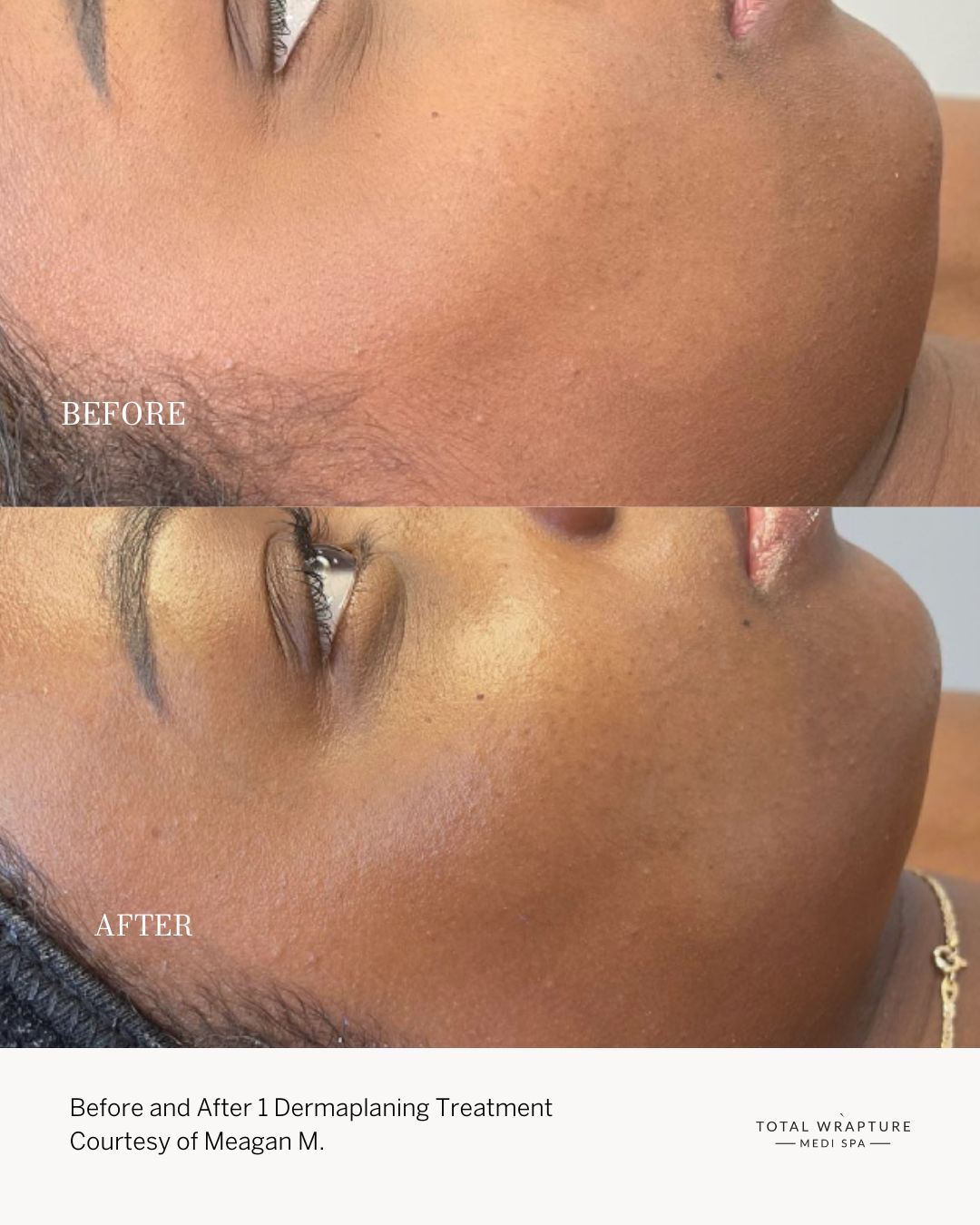 Dermaplaning Treatment before and after Dermaplaning before and after