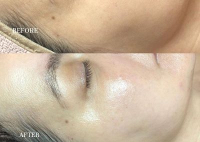 Dermaplaning before and after results