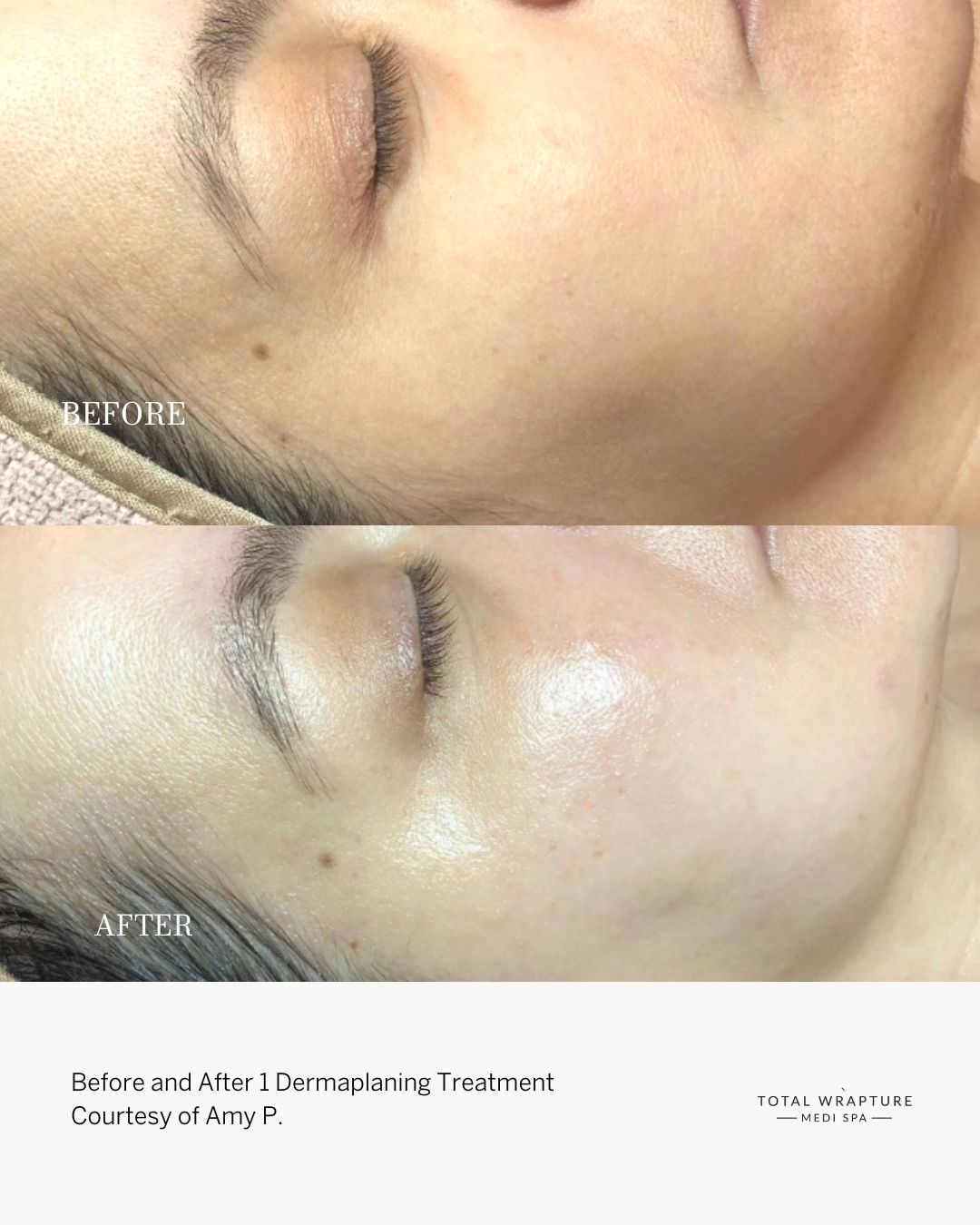 Dermaplaning before and after Dermaplaning before and after results