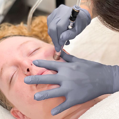 Microdermabrasion at Total Wrapture Medi Spa Winnipeg
