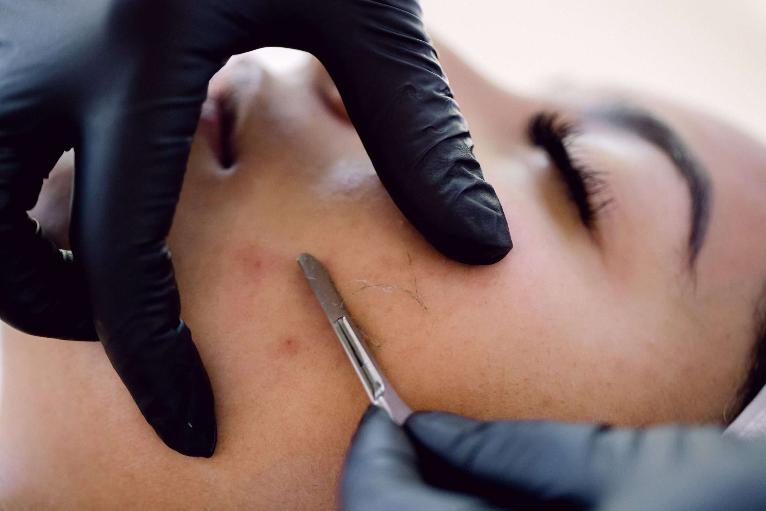 Dermaplaning facial Dermaplaning facial on client's cheek. Facial treatments in Winnipeg