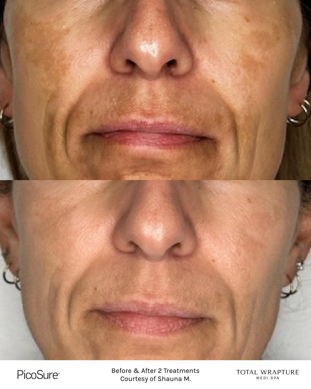 Winnipeg Melasma Laser Treatment Results before and after results