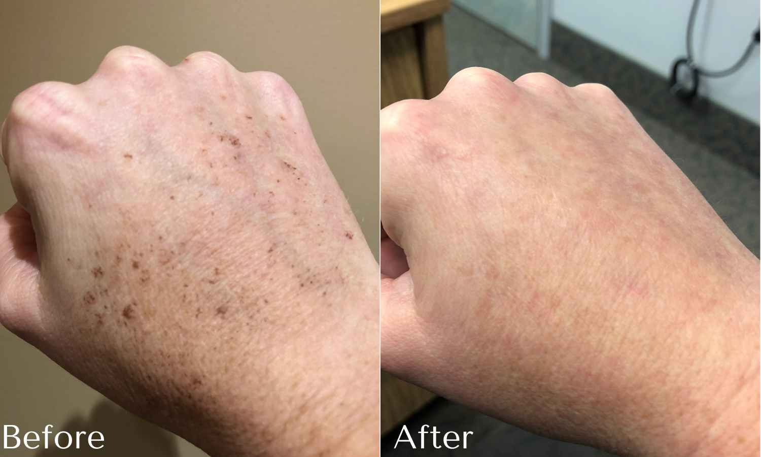 Photofacial Laser photofacial before and after results on hand