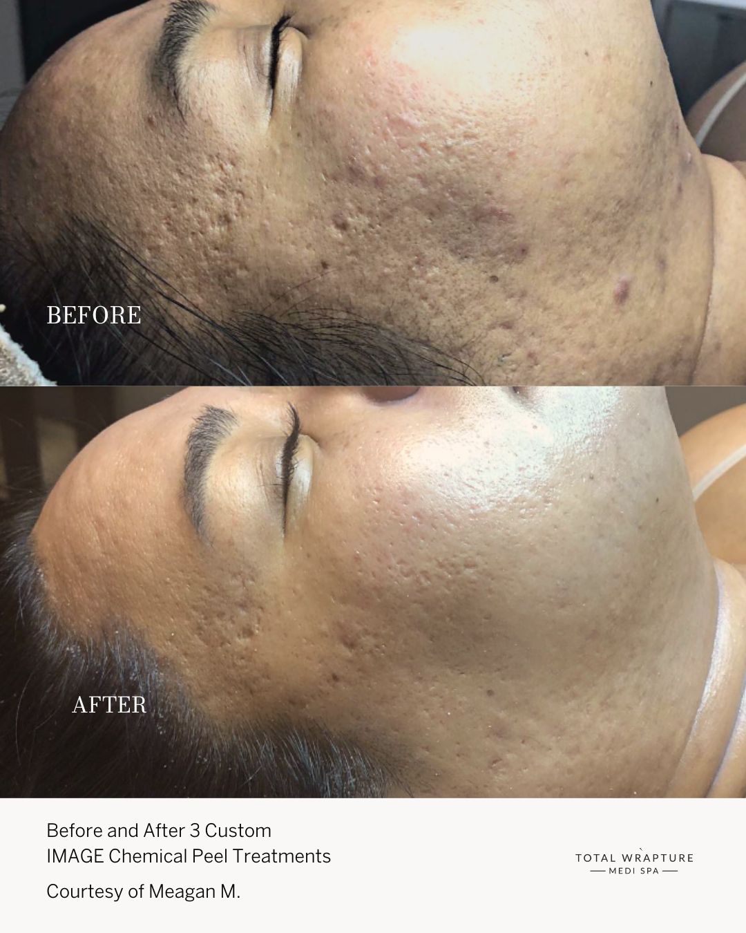 Chemical Peel before and after