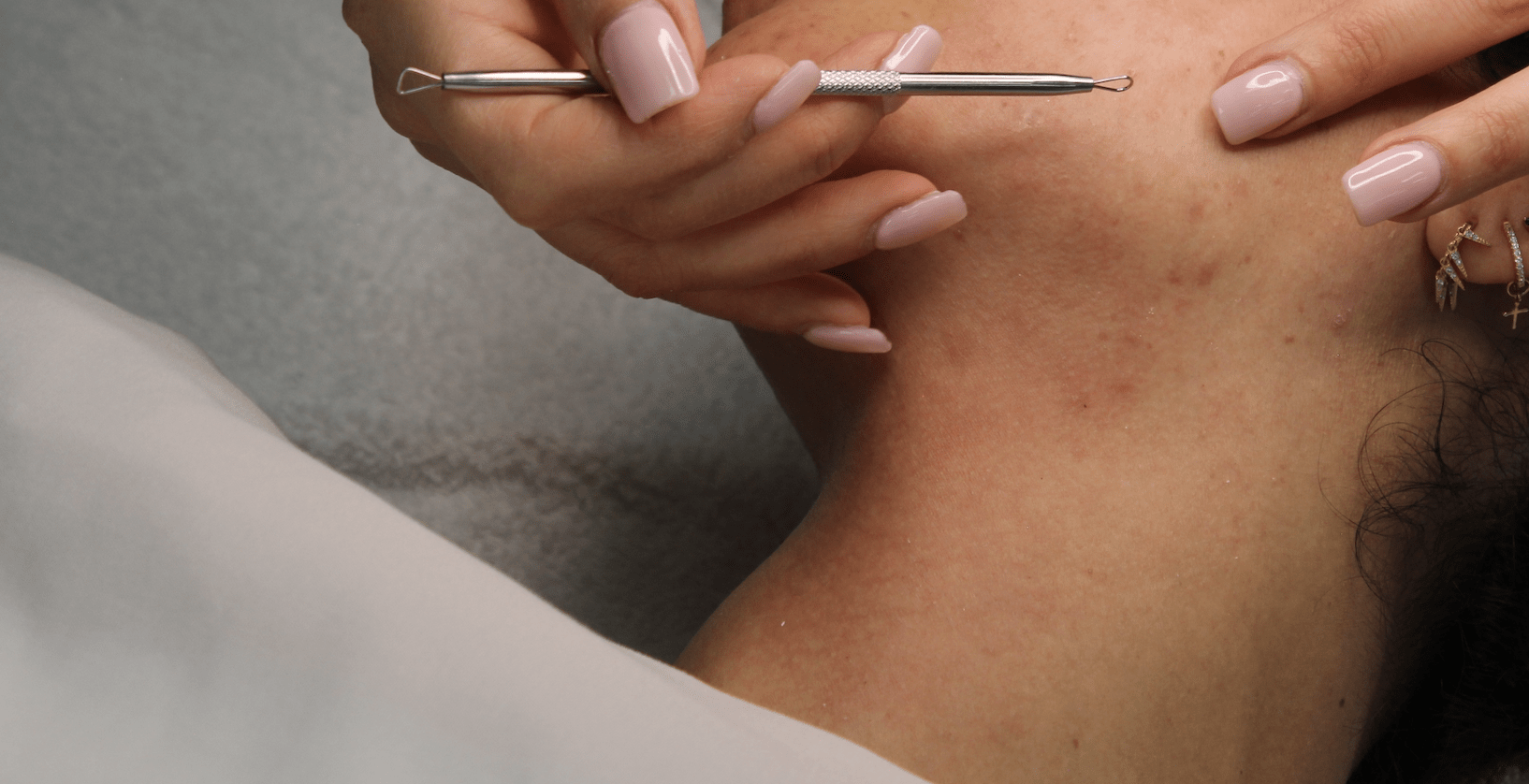 facials winnipeg facial extractions on the cheek.