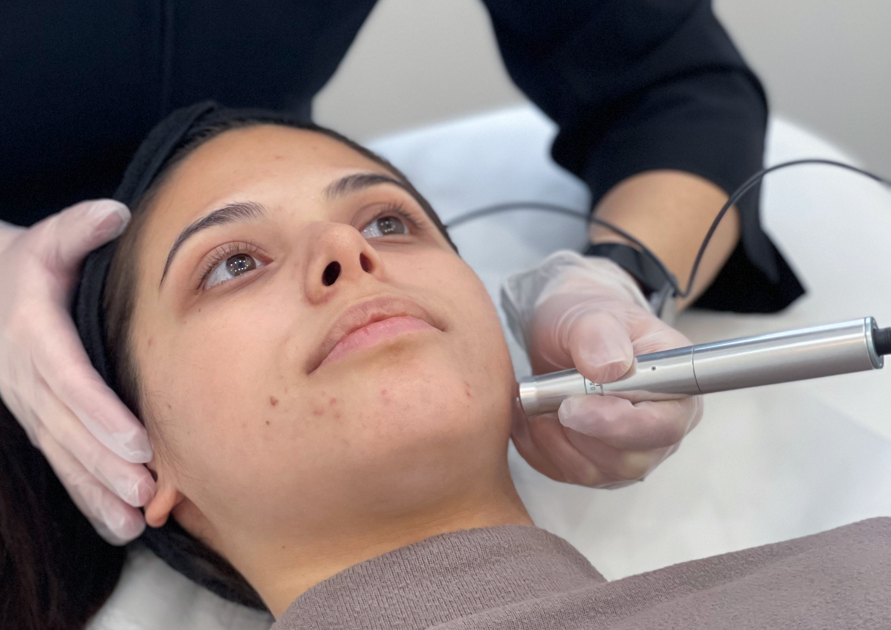 microneedling for acne scars
