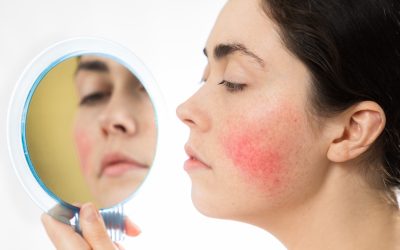 Rosacea and Facial Redness: Everything You Need to Know