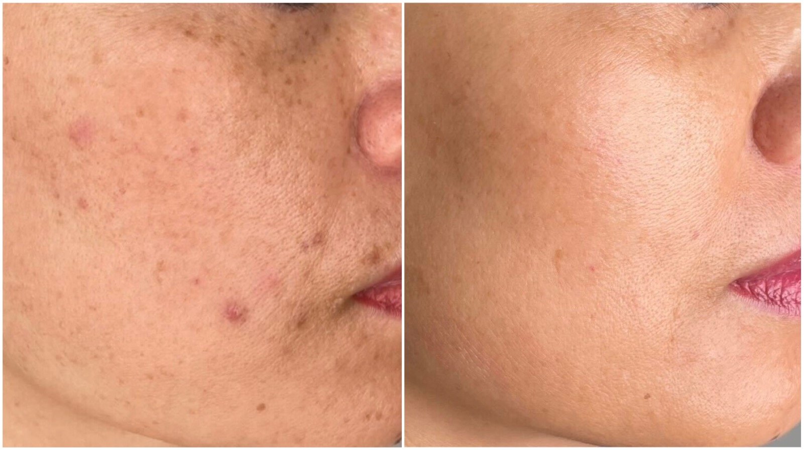 Treatments for hyperpigmentation winnipeg before and after hyperpigmentation treatment.