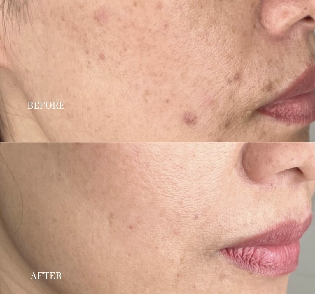 Website BEFORE & Afters - 30 person with green eyes and freckles who knos how to prevent hyperpigmentatiion