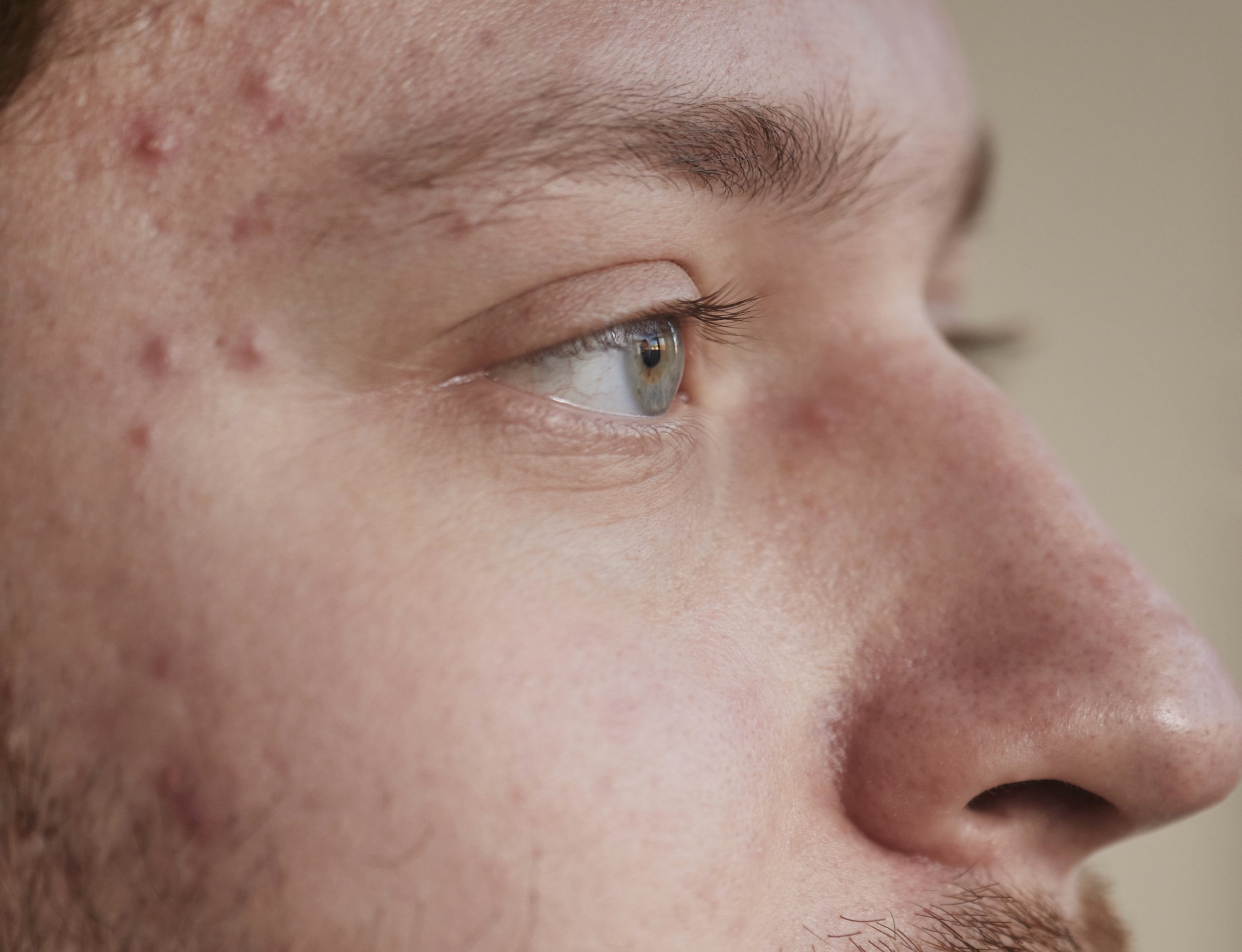 Winnipeg acne solutions
