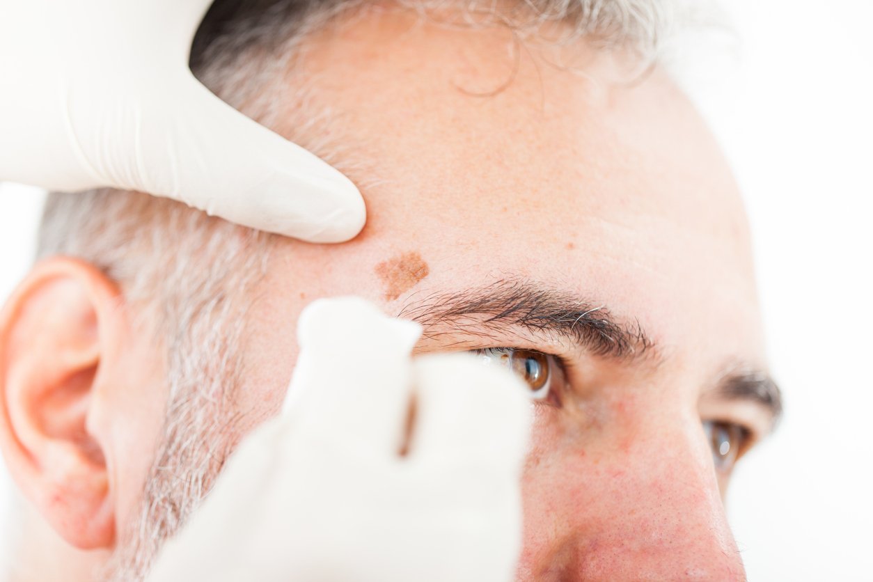 Liver spots and age spots hyperpigmentation treatments and products Liver spots and age spots hyperpigmentation treatments and products
