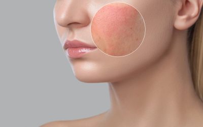 Soothe and Protect: The Redness-Reducing Skincare Pairing