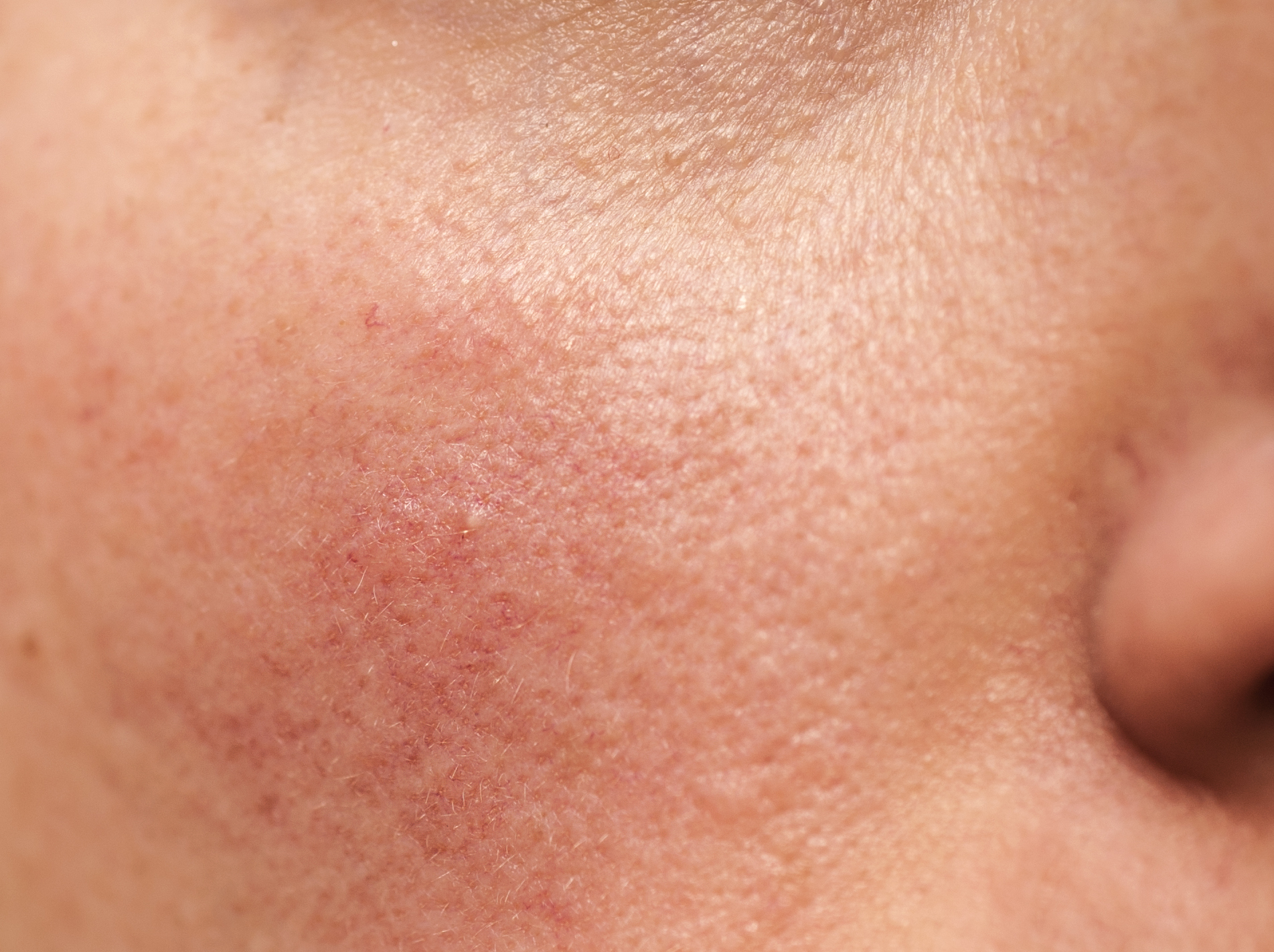redness rosacea solutions redness rosacea solutions