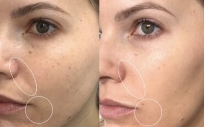 Can crepey skin really be fixed?