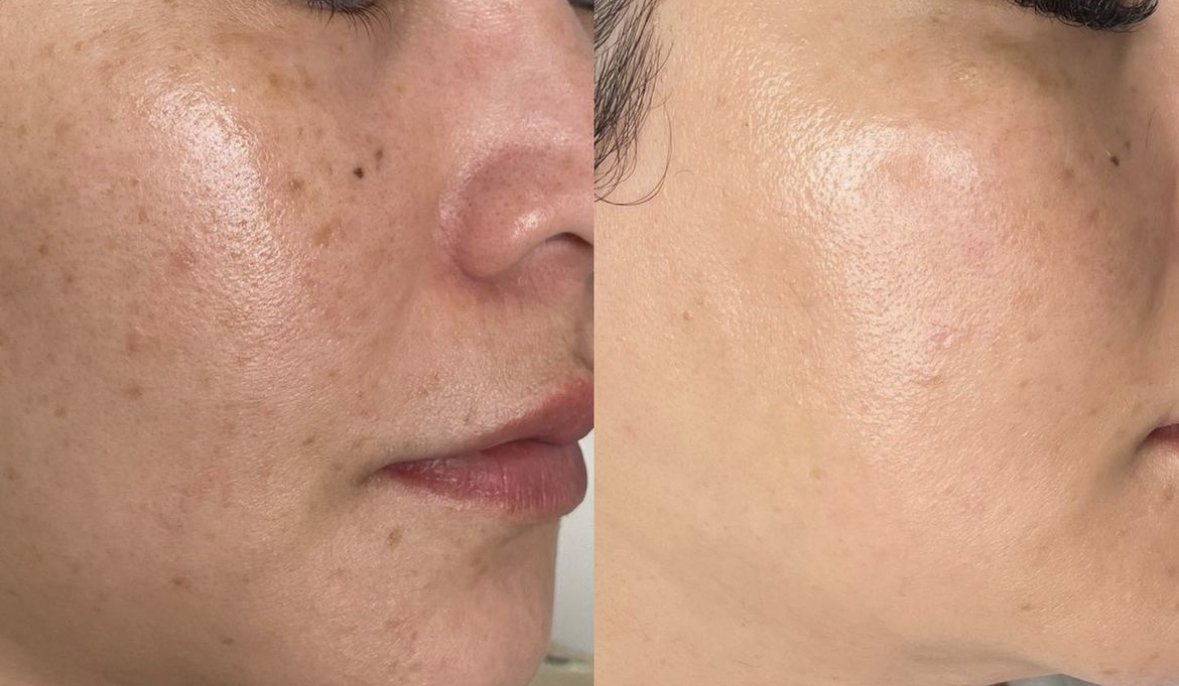 2x PicoSure pigmentation laser acne scar treatment winnipeg pigmentation laser