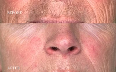 Can crepey skin really be fixed?