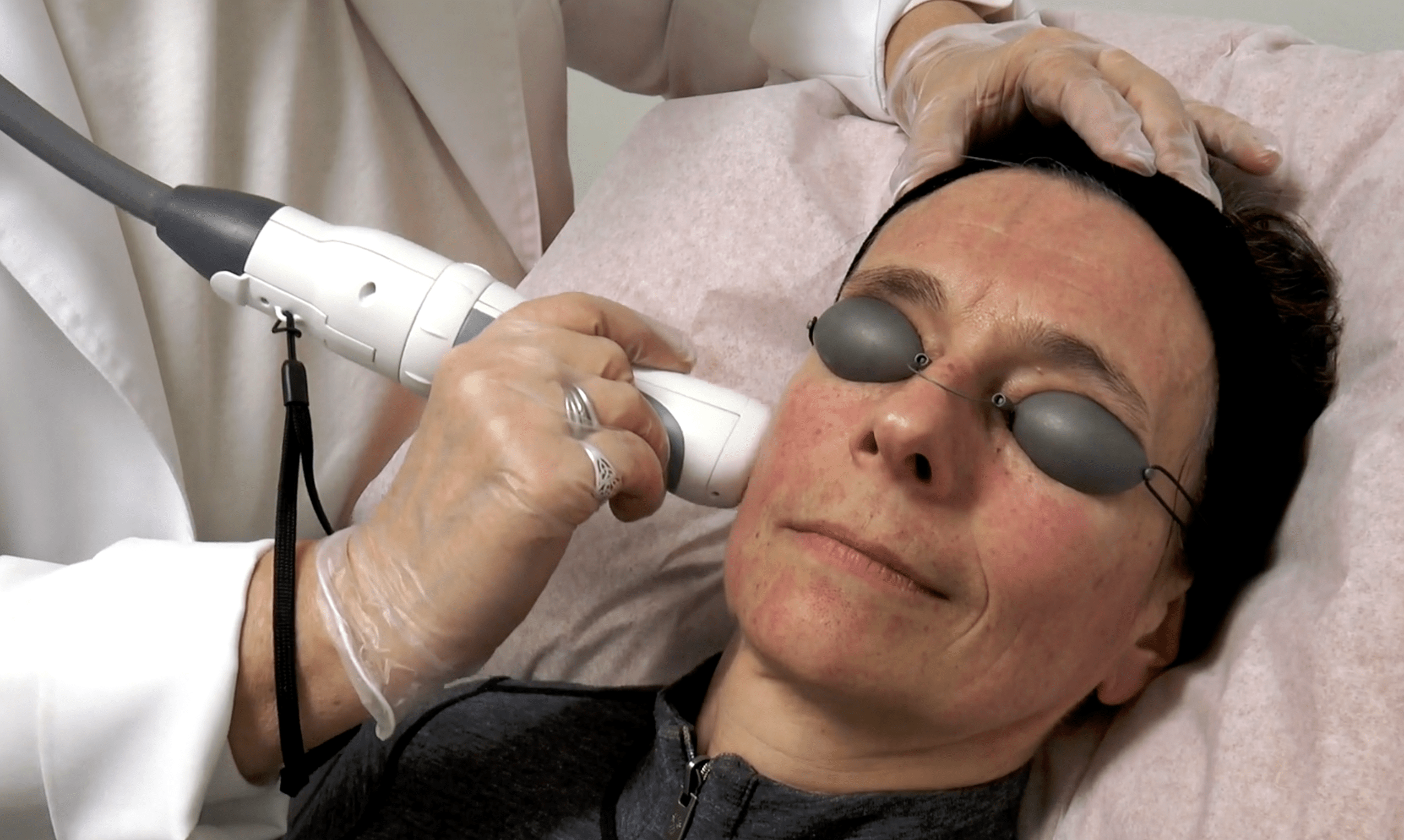 Fractional laser three for me