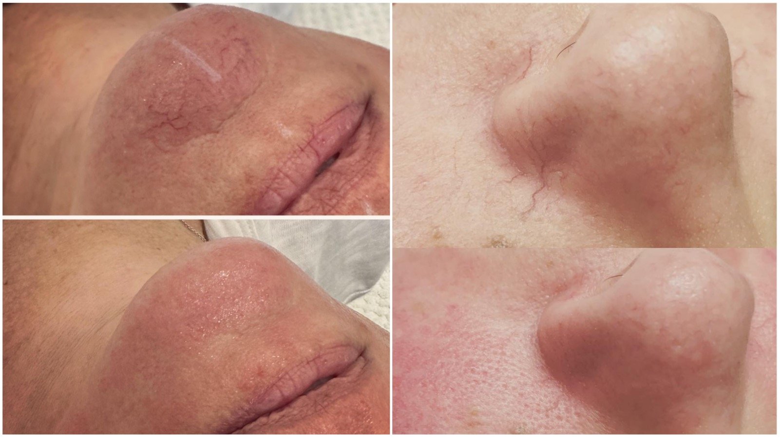 "Visible broken capillaries on the skin before and after undergoing a photofacial treatment."