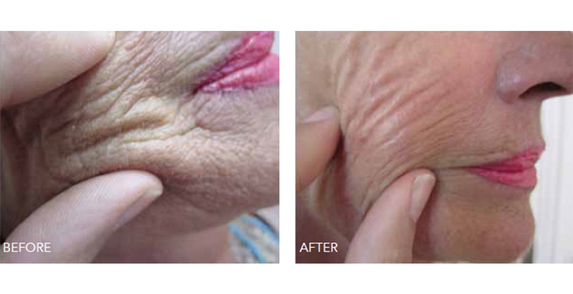 Winnipeg Skin Clinic - Revolumizing Beauty Booster Difference before and after a beauty booster treatment. Skin appears less wrinkled.