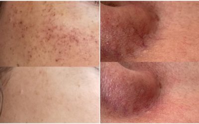 The Cost of Skin Lesions Treatment in Winnipeg: What Influences the Price?