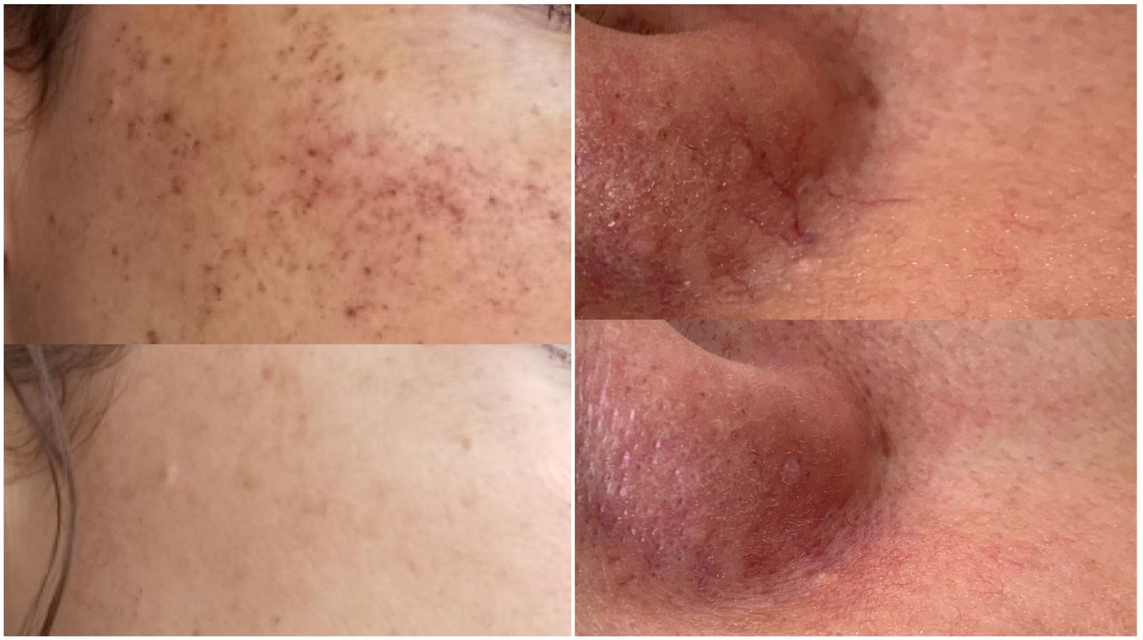 broken capillaries treatment winnipeg "Comparison of skin with broken facial vessels before and after a photofacial procedure."