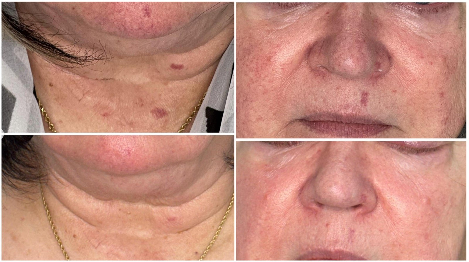 photofacial winnipeg "Skin showing broken facial vessels before and after a photofacial."