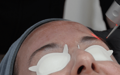 What Laser Treatments Make You Look Younger?
